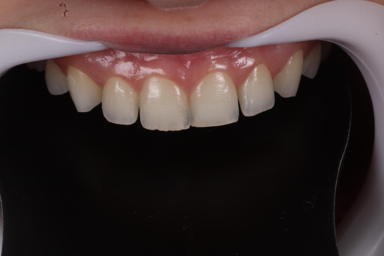 Reanatomização anterior antes